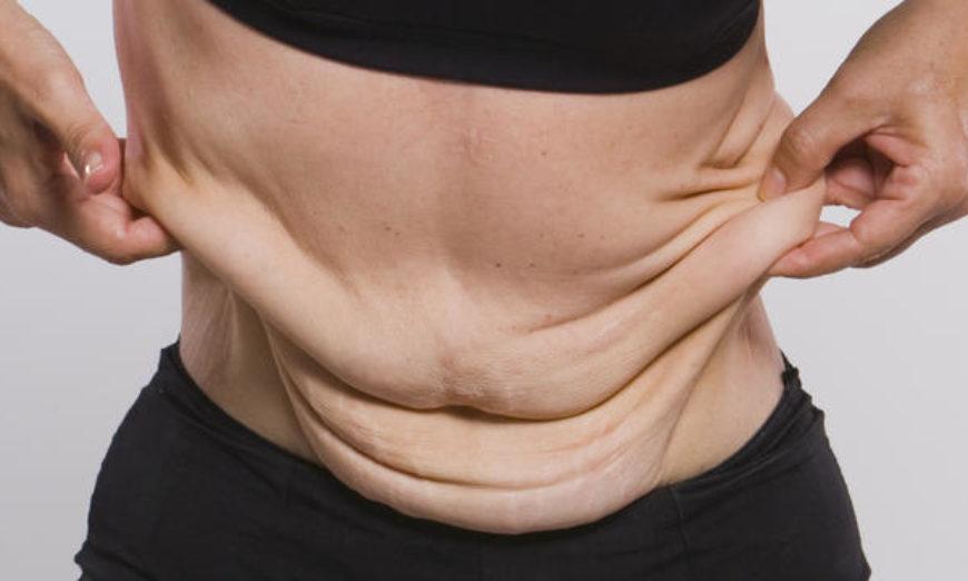 Cirurgia plástica pós bariátrica