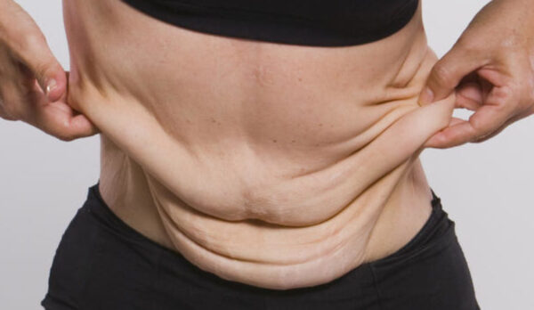 Excess of flesh is a result of bariatric (gastric bypass) surgery