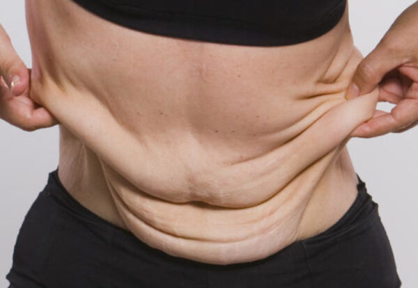Excess of flesh is a result of bariatric (gastric bypass) surgery
