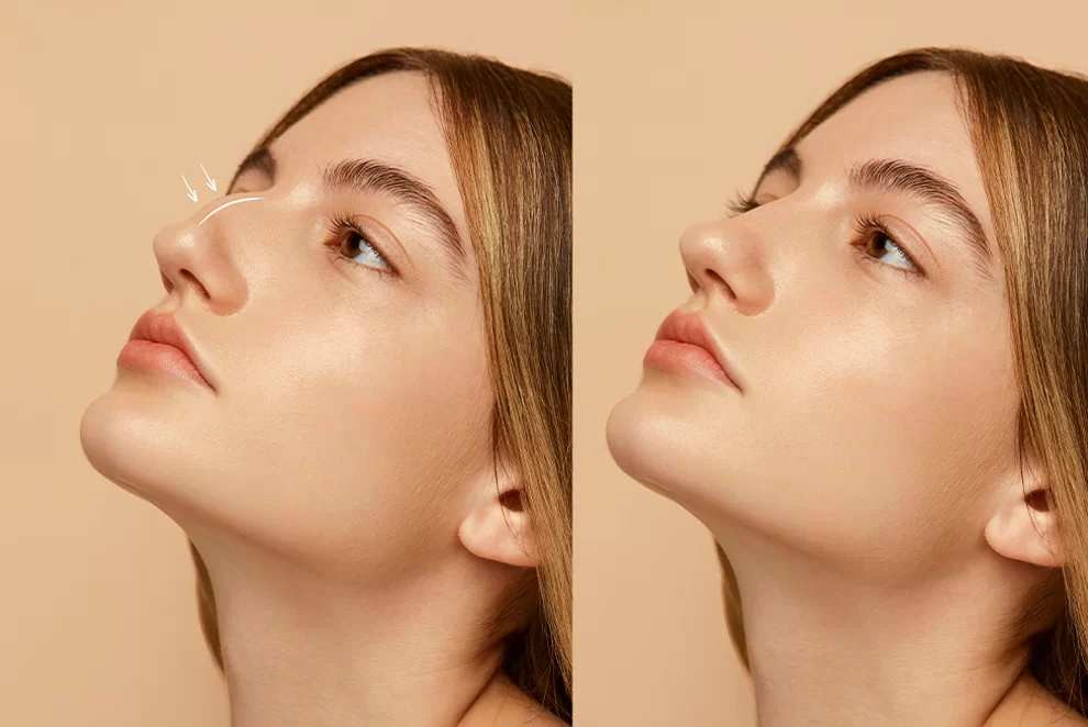 Técnicas Avançadas de Rinoplastia no Rio de Janeiro Dra. Silvia Hirata