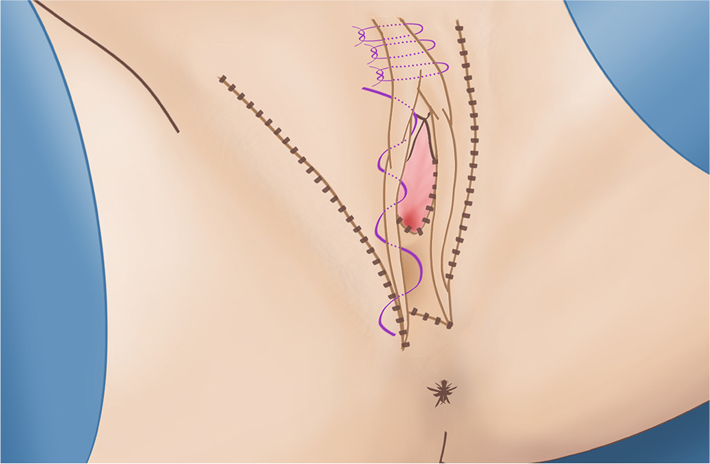 Como é Feita a Cirurgia Íntima Feminina, dra. silvia hirata, rio de janeiro